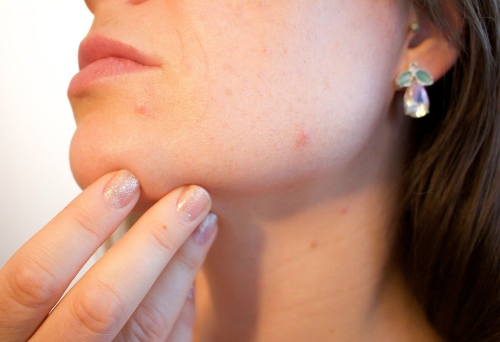 ACNEEA -  Cate tipuri de acnee exista si cum pot fi combatute?