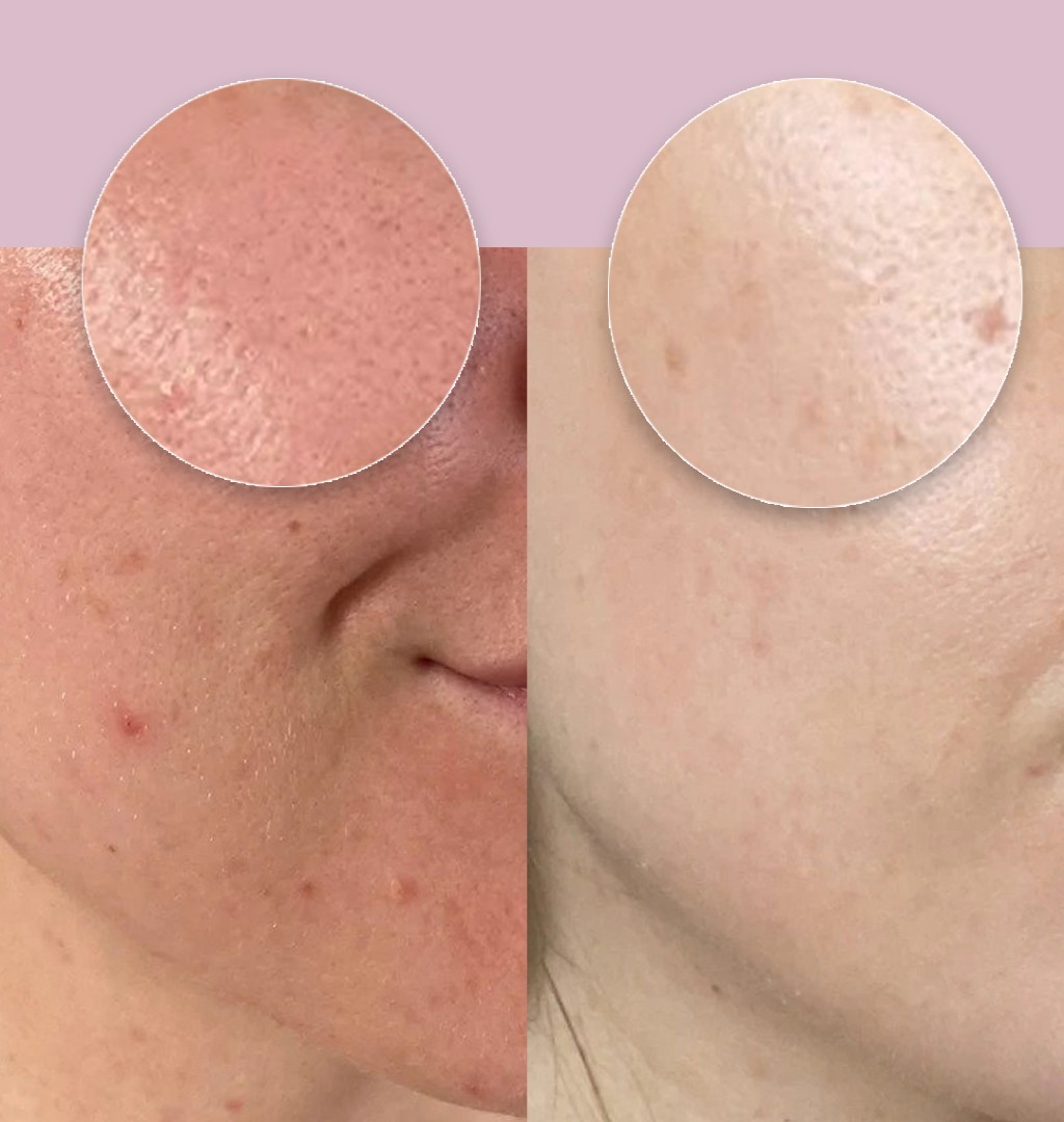 Retinol, ce este si ce beneficii ofera, care sunt contraindicatiile si ce alternative naturale exista
